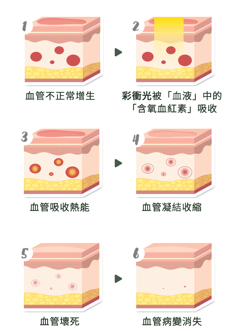 M22彩衝光_血管酒糟治療說明圖