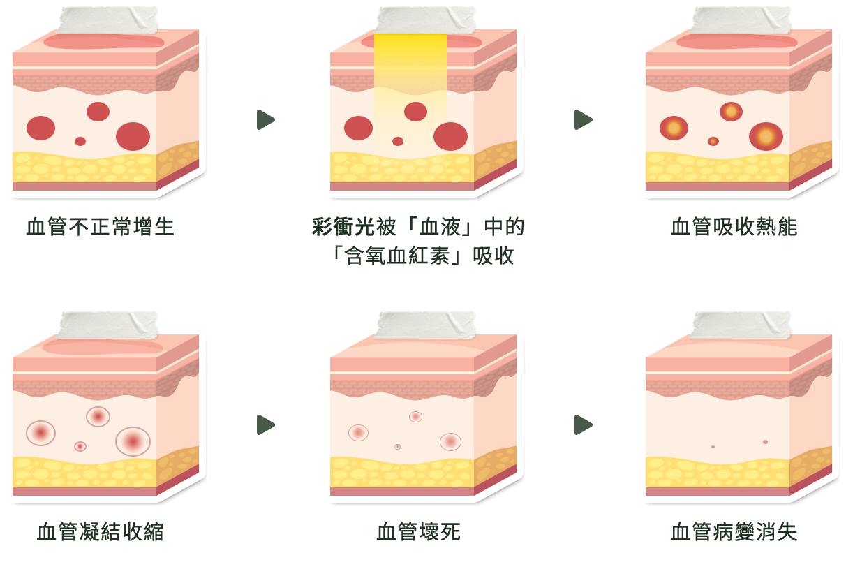 M22彩衝光_血管酒糟治療說明圖