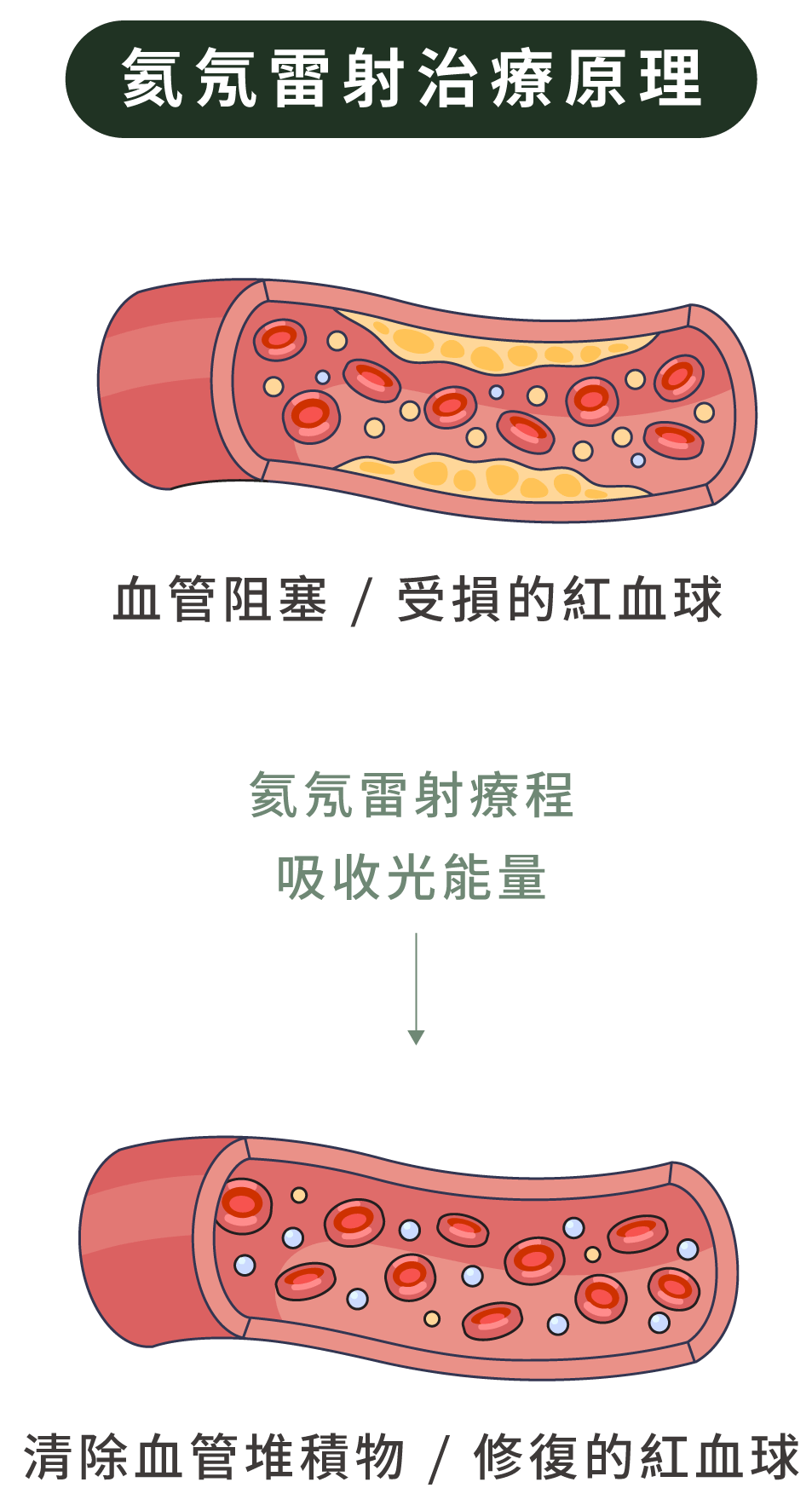 氦氖雷射治療原理-透過氦氖雷射療程，活化紅血球與白血球，清除血管堆積物、修復紅血球